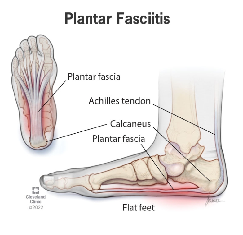 Backdate 1 Plantar Fasciitis: Symptoms, Causes & Treatment Options