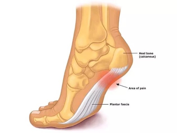 Backdate 1 Top  Plantar Fasciitis Treatments For Lasting Relief