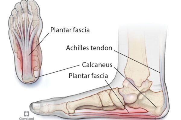 Kick Plantar Fasciitis To The Curb: Easy Ways To Banish Foot Pain