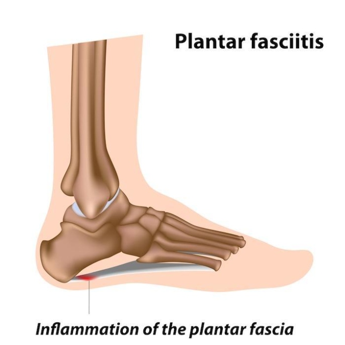 Happy Feet: Easy Tips To Prevent Plantar Fasciitis For Pain-Free Walking