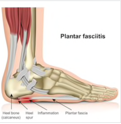 Backdate 3 Tips For Runners: How To Prevent Plantar Fasciitis